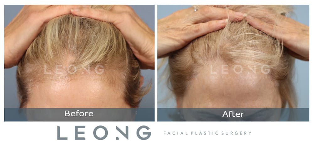 Hair Transplant Before & After Gallery - Patient 214973 - Image 3