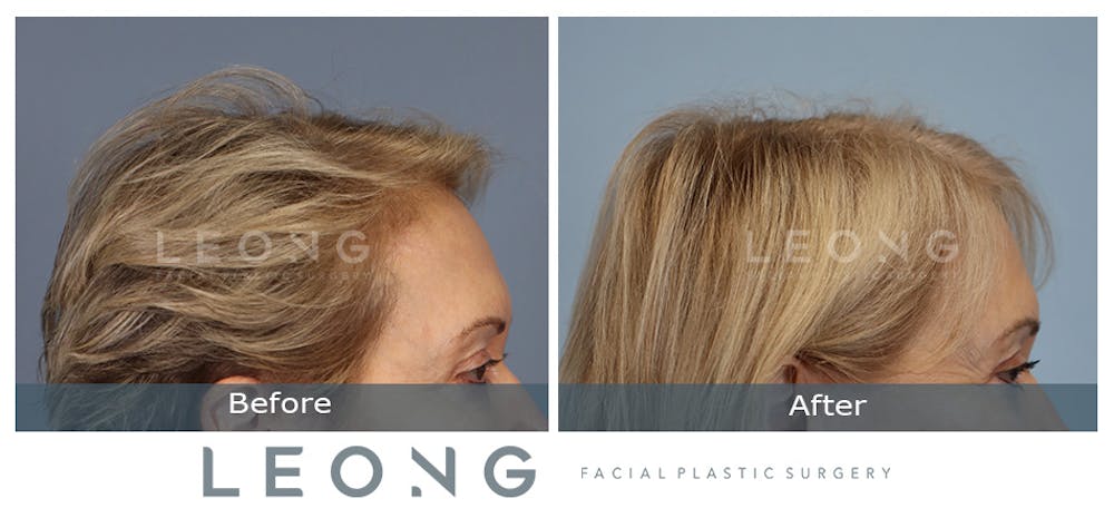 Hair Transplant Before & After Gallery - Patient 214973 - Image 5
