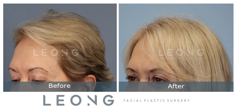 Hair Transplant Before & After Gallery - Patient 214973 - Image 6