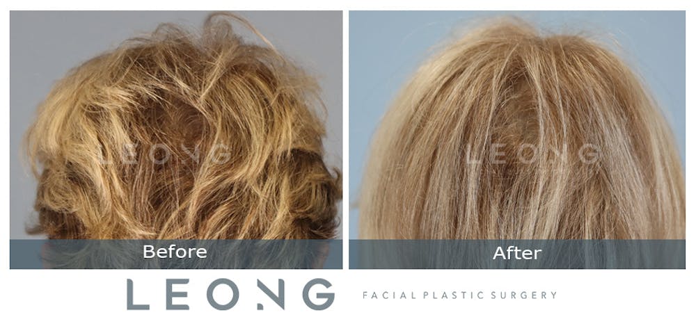 Hair Transplant Before & After Gallery - Patient 214973 - Image 8