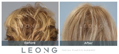 Hair Transplant Before & After Gallery - Patient 214973 - Image 8