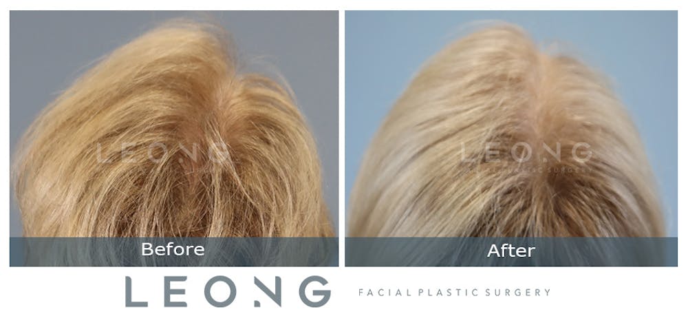 Hair Transplant Before & After Gallery - Patient 214973 - Image 9