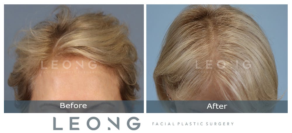 Hair Transplant Before & After Gallery - Patient 214973 - Image 2