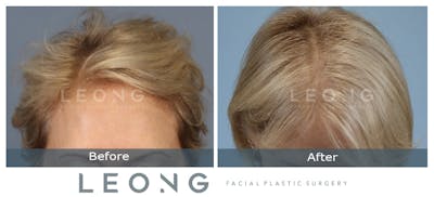 Hair Transplant Before & After Gallery - Patient 214973 - Image 2