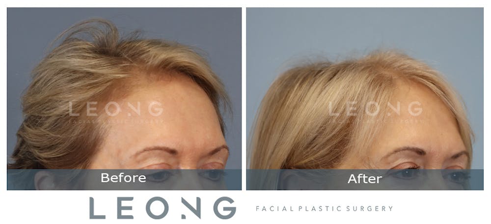 Hair Transplant Before & After Gallery - Patient 214973 - Image 4