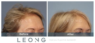 Hair Transplant Before & After Gallery - Patient 214973 - Image 4