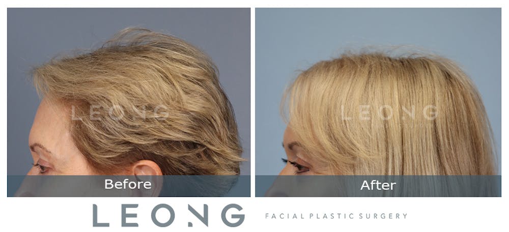 Hair Transplant Before & After Gallery - Patient 214973 - Image 7