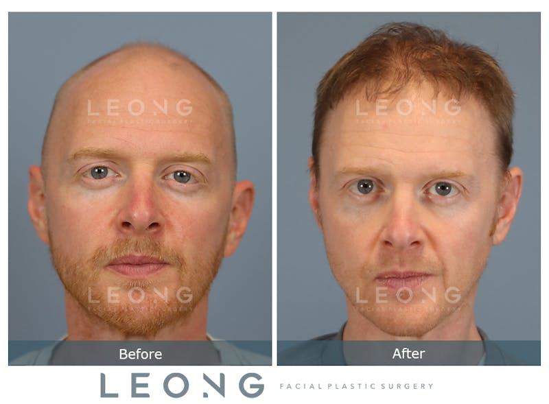 Hair Transplant Before & After Gallery - Patient 229259 - Image 1