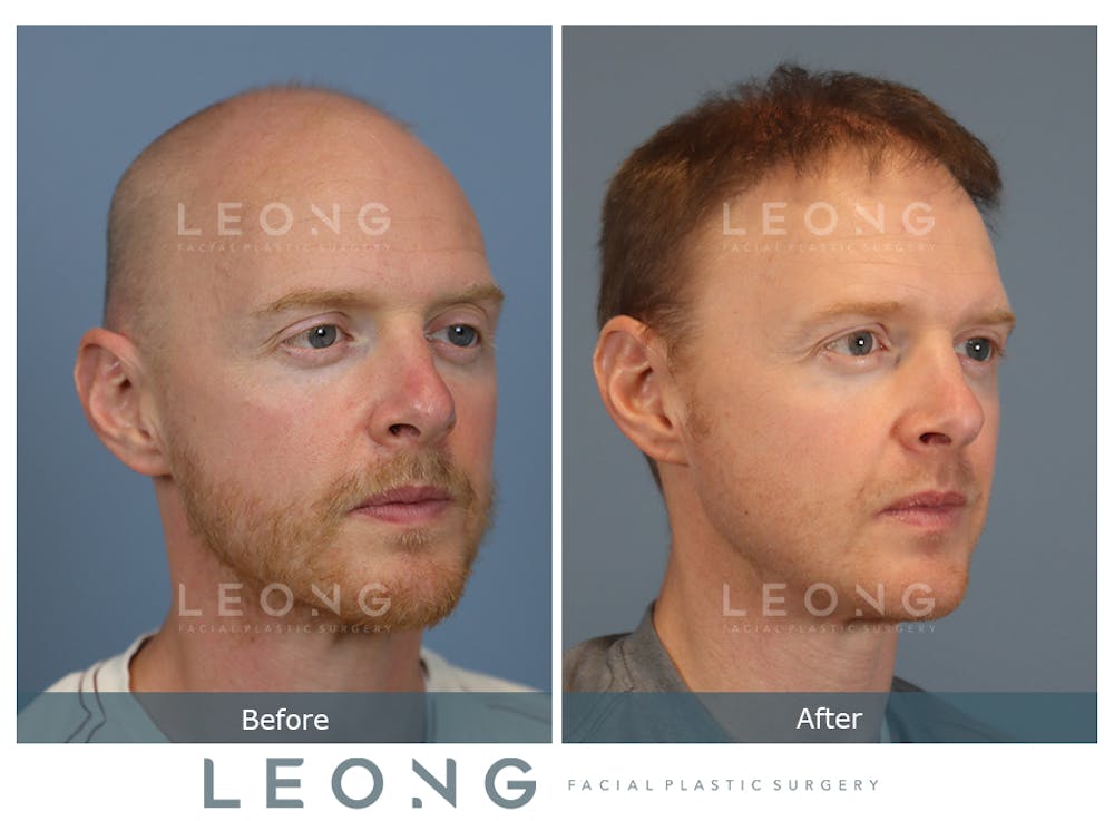 Hair Transplant Before & After Gallery - Patient 229259 - Image 4