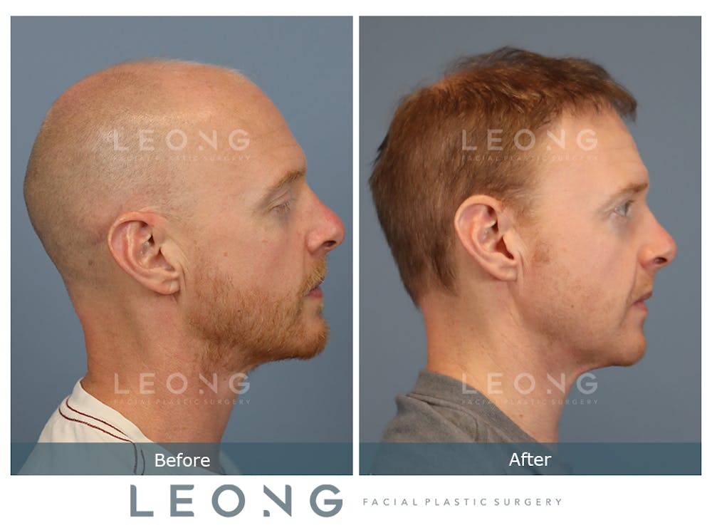 Hair Transplant Before & After Gallery - Patient 229259 - Image 5