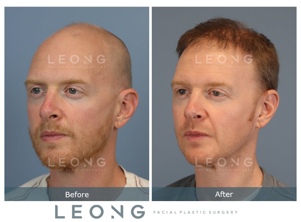 Hair Transplant Before & After Gallery - Patient 229259 - Image 2