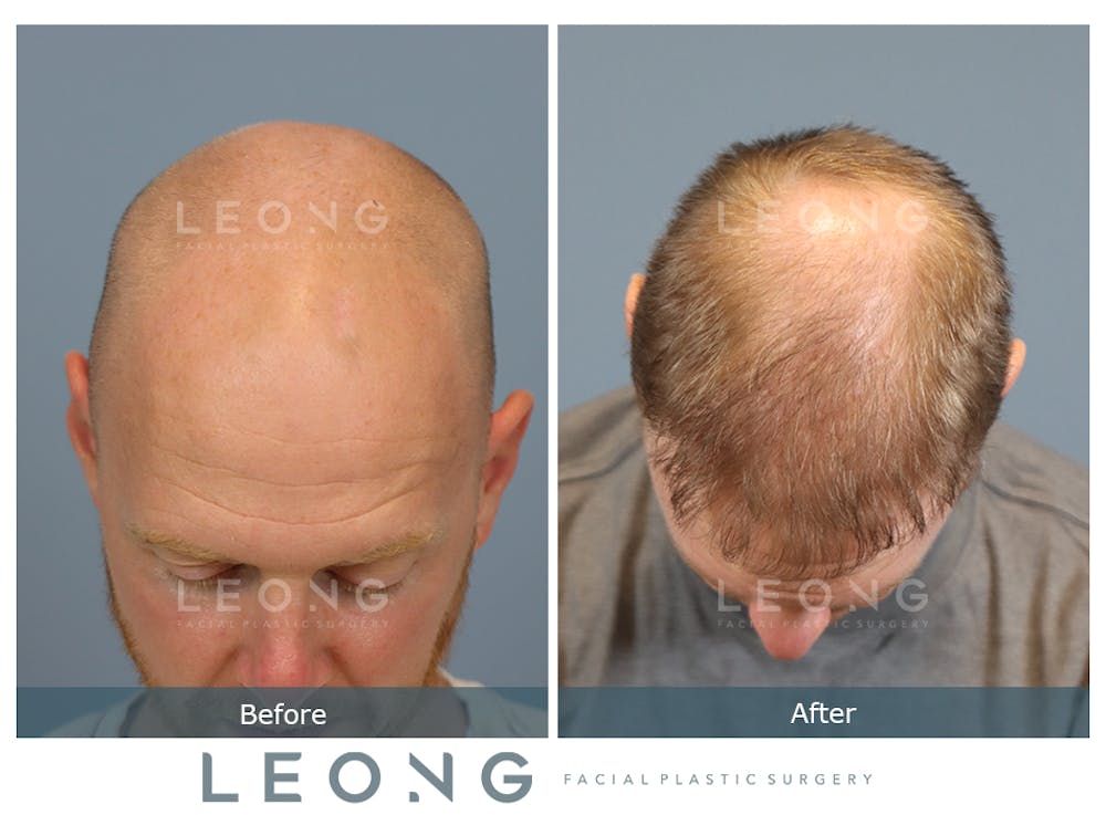 Hair Transplant Before & After Gallery - Patient 229259 - Image 6