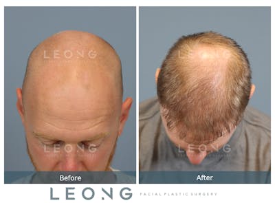 Hair Transplant Before & After Gallery - Patient 229259 - Image 6