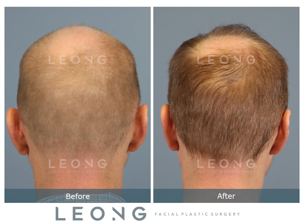 Hair Transplant Before & After Gallery - Patient 229259 - Image 7