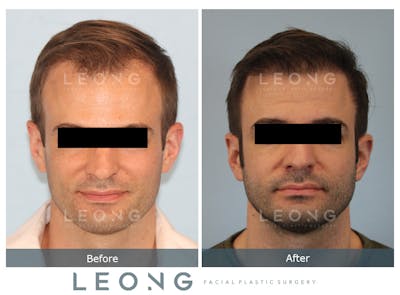 Hair Transplant Before & After Gallery - Patient 179984 - Image 1
