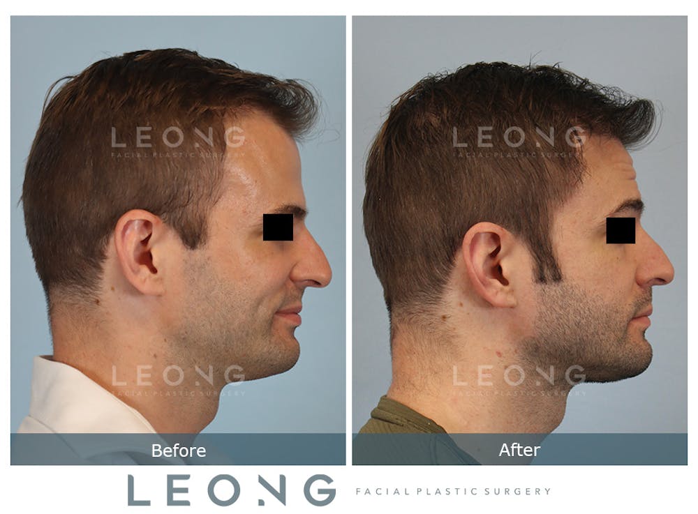 Hair Transplant Before & After Gallery - Patient 179984 - Image 3