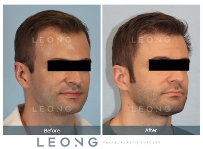 Hair Transplant Before & After Gallery - Patient 179984 - Image 2
