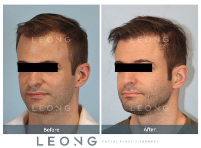 Hair Transplant Before & After Gallery - Patient 179984 - Image 4