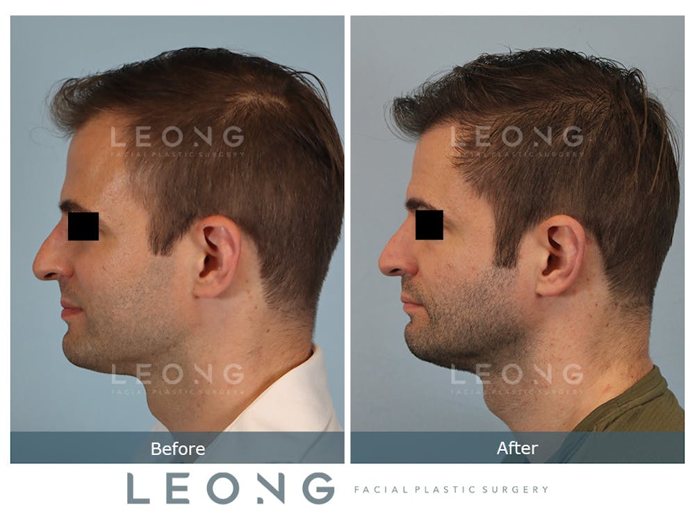 Hair Transplant Before & After Gallery - Patient 179984 - Image 5