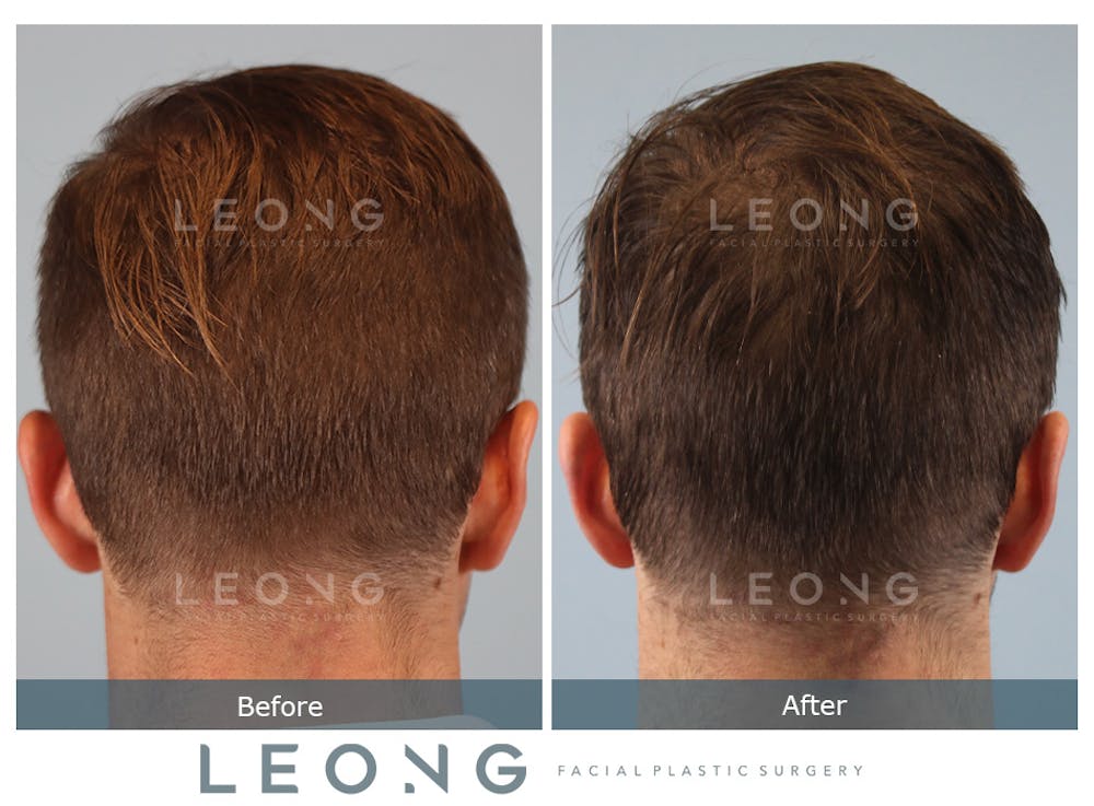 Hair Transplant Before & After Gallery - Patient 179984 - Image 7
