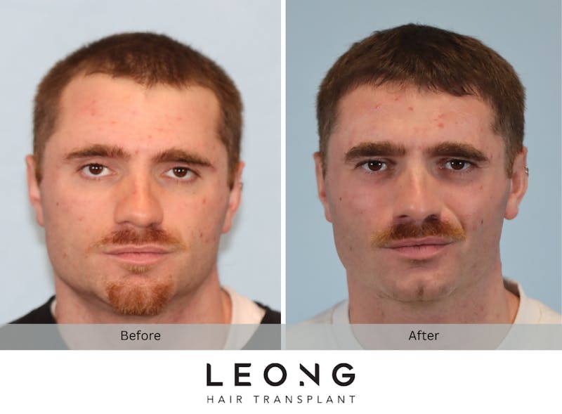 Hair Transplant Before & After Gallery - Patient 297008 - Image 1