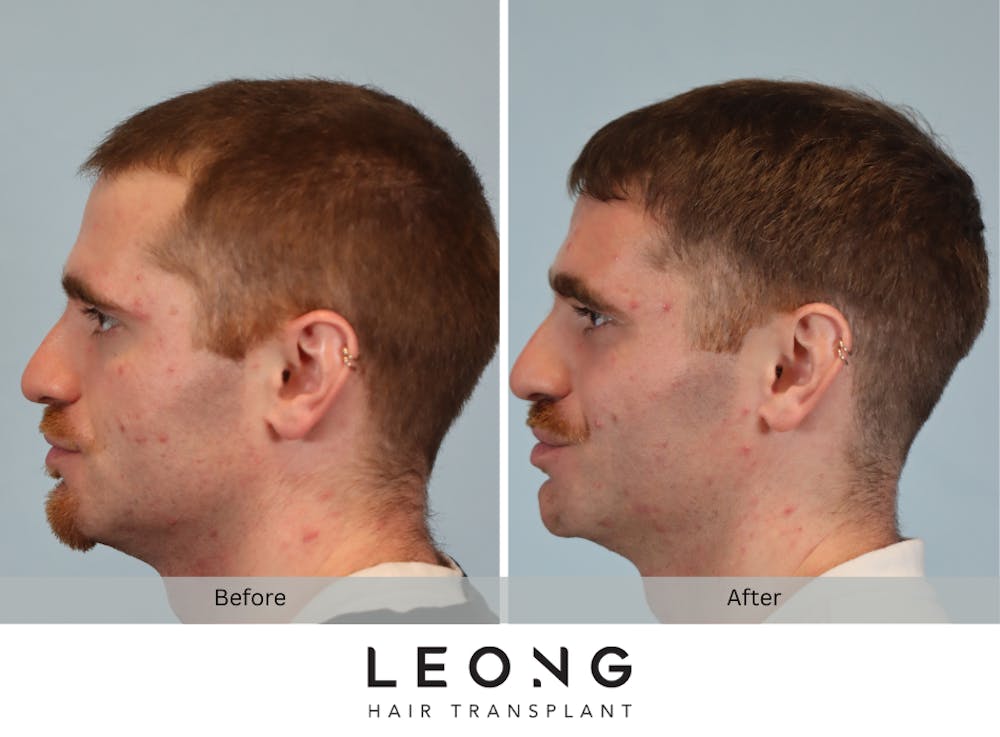 Hair Transplant Before & After Gallery - Patient 297008 - Image 5