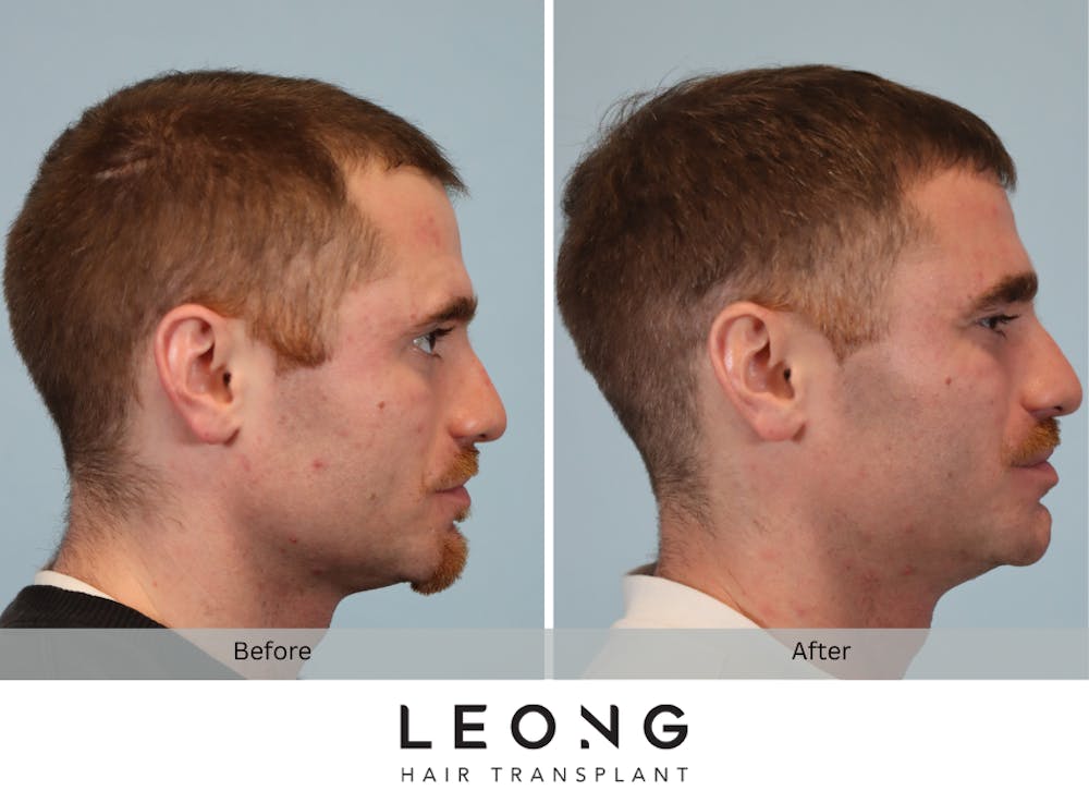 Hair Transplant Before & After Gallery - Patient 297008 - Image 4