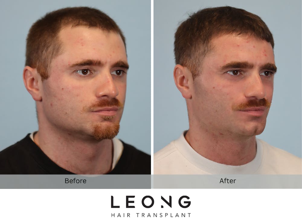 Hair Transplant Before & After Gallery - Patient 297008 - Image 3