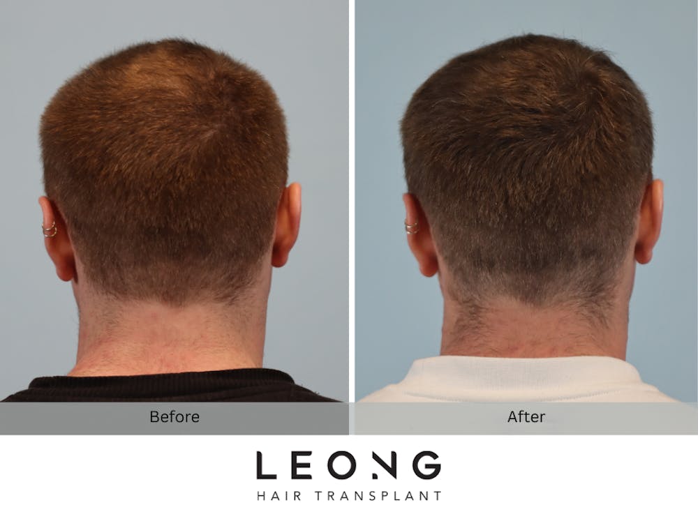 Hair Transplant Before & After Gallery - Patient 297008 - Image 7