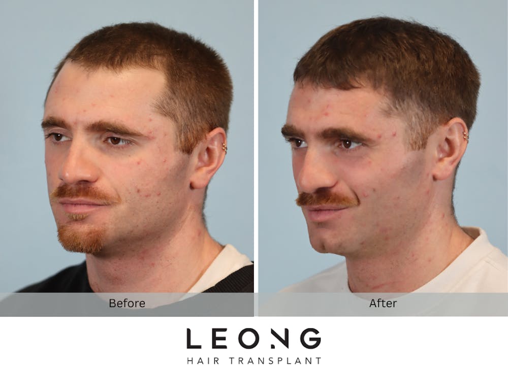Hair Transplant Before & After Gallery - Patient 297008 - Image 6