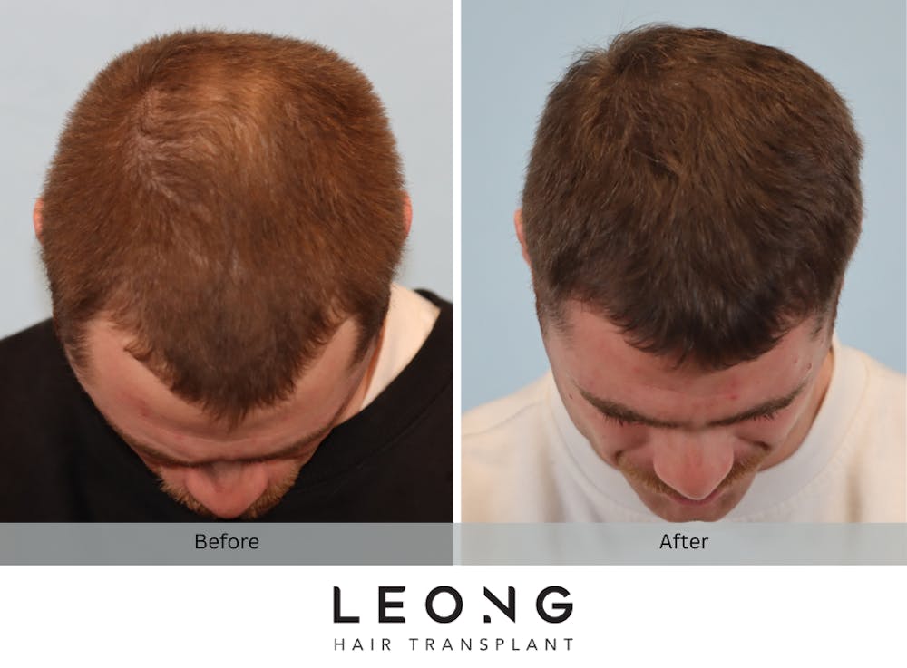 Hair Transplant Before & After Gallery - Patient 297008 - Image 2