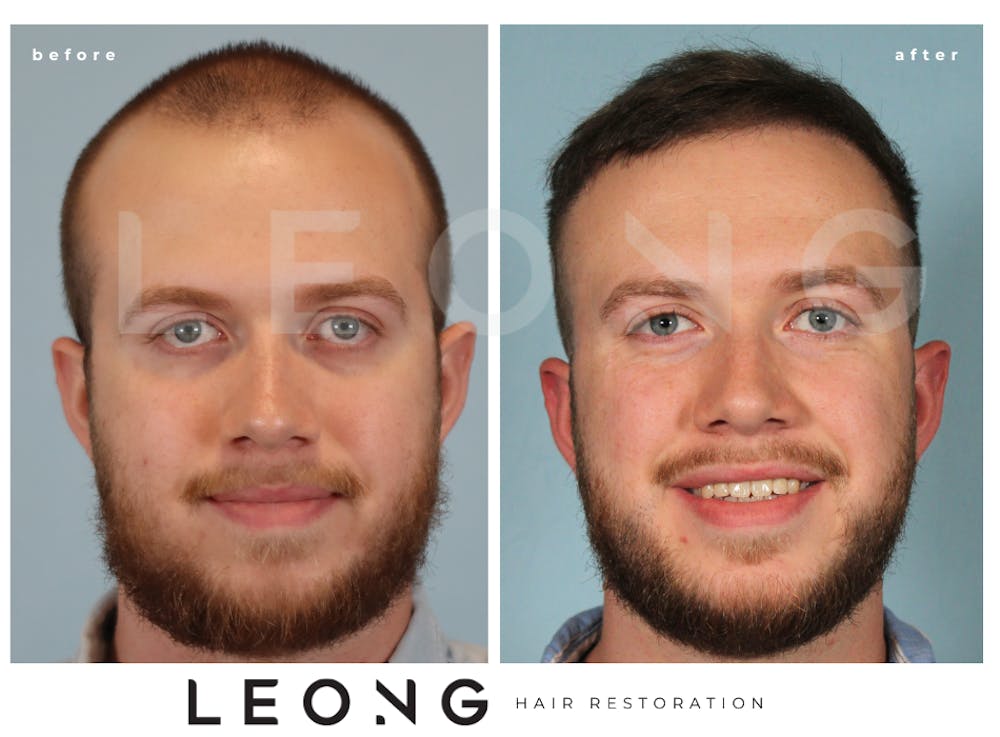 Hair Transplant Before & After Gallery - Patient 352449 - Image 3