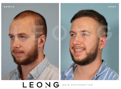 Hair Transplant Before & After Gallery - Patient 352449 - Image 1