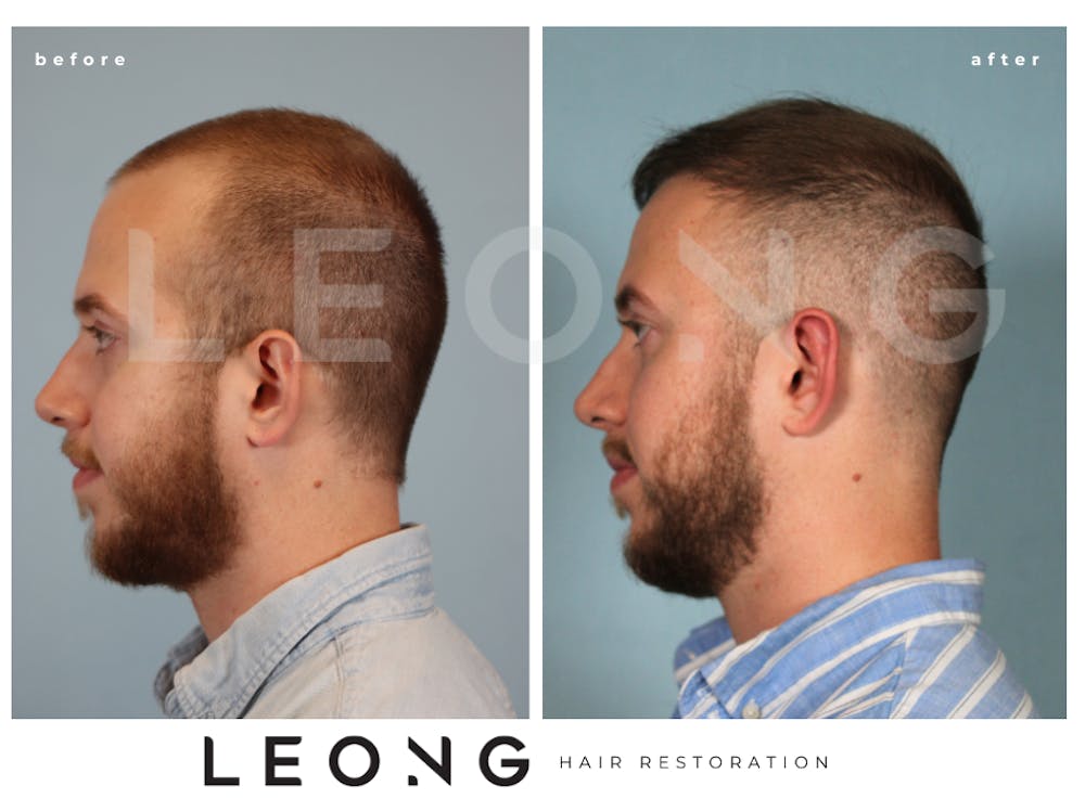 Hair Transplant Before & After Gallery - Patient 352449 - Image 5