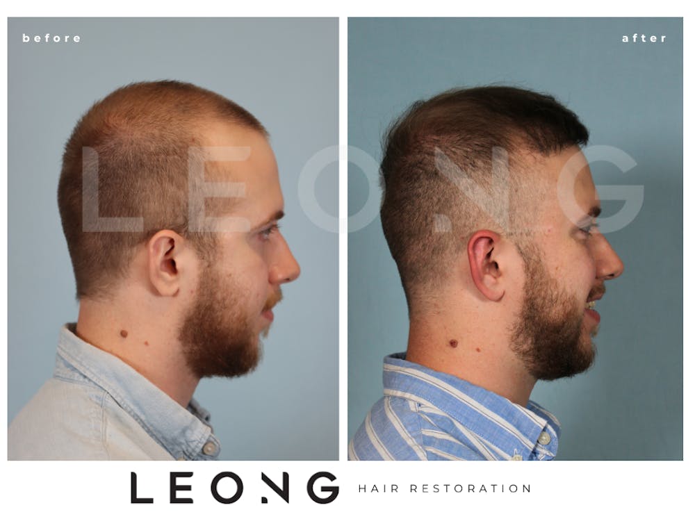 Hair Transplant Before & After Gallery - Patient 352449 - Image 4