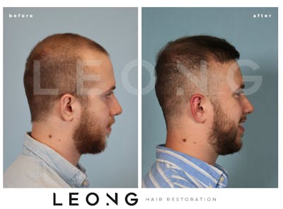 Hair Transplant Before & After Gallery - Patient 352449 - Image 4