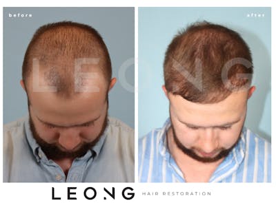 Hair Transplant Before & After Gallery - Patient 352449 - Image 2