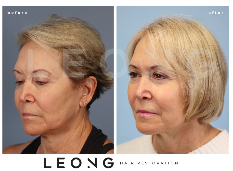 Hair Transplant Before & After Gallery - Patient 140932 - Image 2
