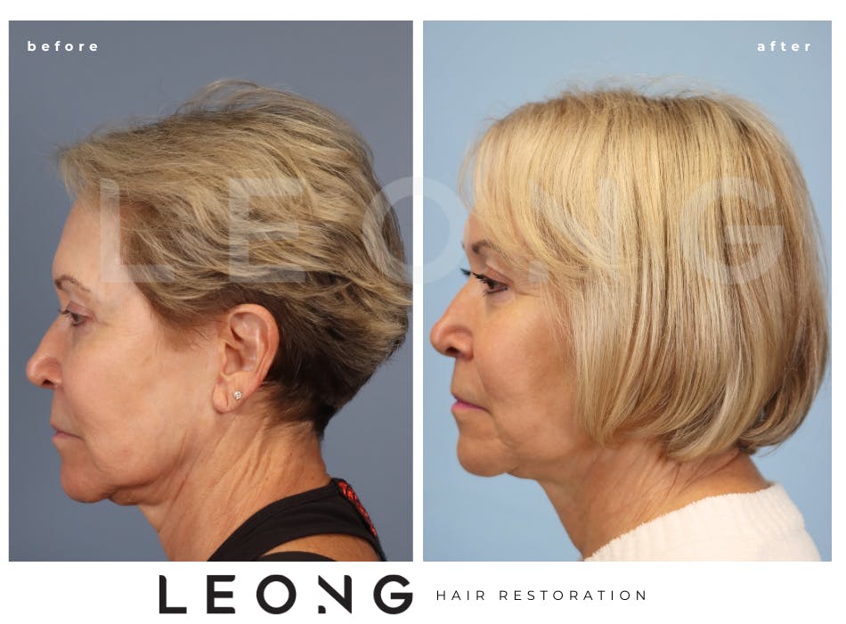 Hair Transplant Before & After Gallery - Patient 140932 - Image 5