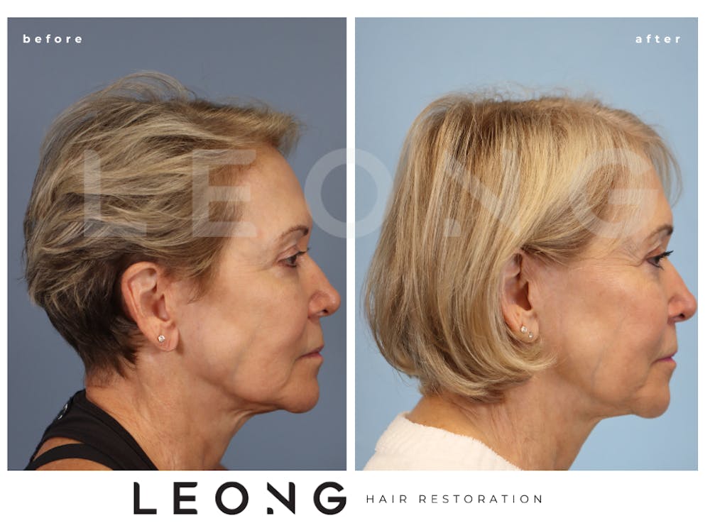 Hair Transplant Before & After Gallery - Patient 140932 - Image 3
