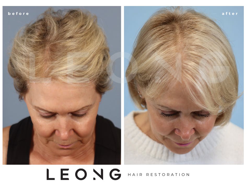 Hair Transplant Before & After Gallery - Patient 140932 - Image 6