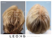 Hair Transplant Before & After Gallery - Patient 140932 - Image 1