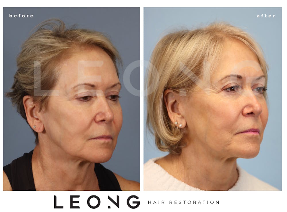 Hair Transplant Before & After Gallery - Patient 140932 - Image 4