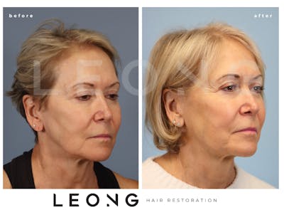 Hair Transplant Before & After Gallery - Patient 140932 - Image 4