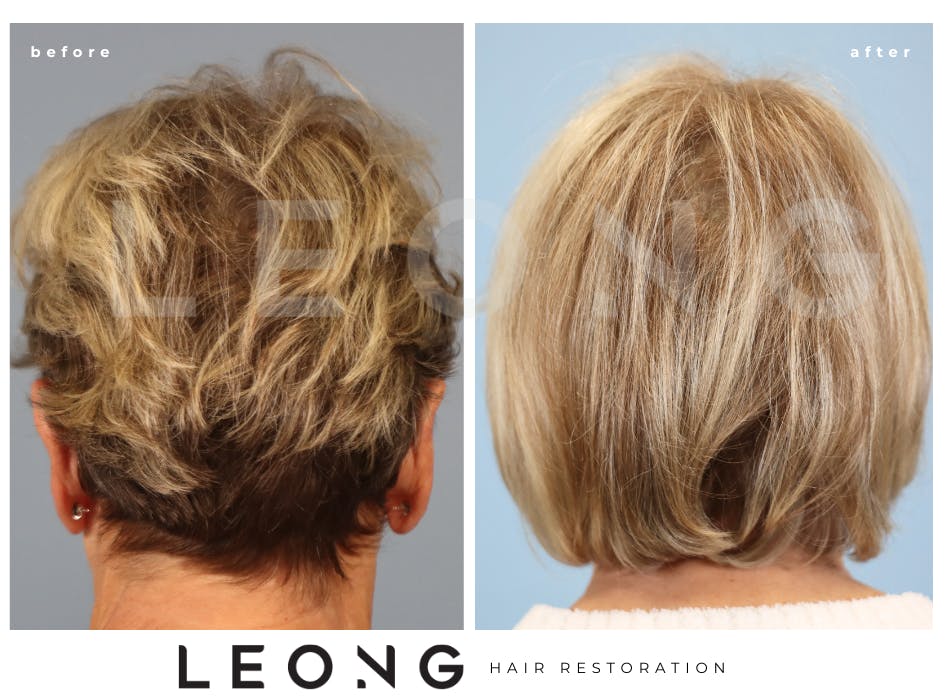 Hair Transplant Before & After Gallery - Patient 140932 - Image 7