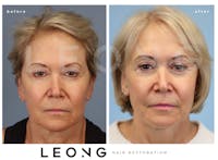 Hair Transplant Before & After Gallery - Patient 140932 - Image 1