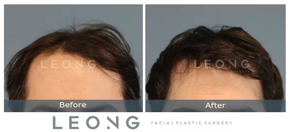 Hair Transplant Before & After Gallery - Patient 327416 - Image 1