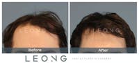 Hair Transplant Before & After Gallery - Patient 327416 - Image 1