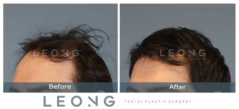 Hair Transplant Before & After Gallery - Patient 327416 - Image 2