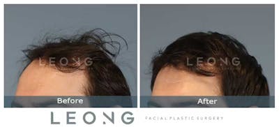 Hair Transplant Before & After Gallery - Patient 327416 - Image 2